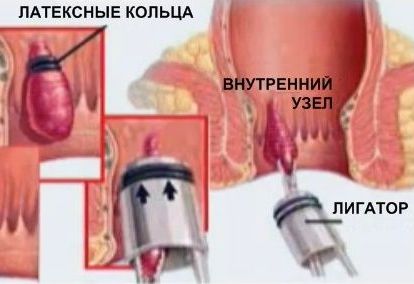 Хронічний та гострий геморой