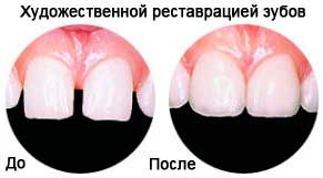 Способи реставрації і відновлення зубів