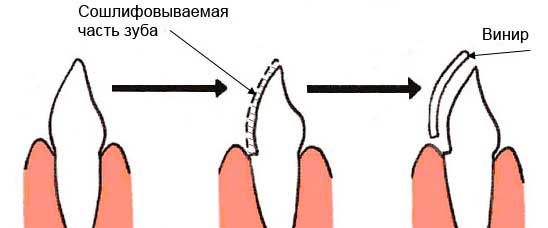 Способи реставрації і відновлення зубів