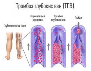 Тромбоз глибоких вен нижніх кінцівок: симптоми на фото і лікування Тромбоз глибоких вен нижніх кінцівок: симптоми на фото і лікування