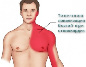 Стенокардія: основні симптоми і лікування народними засобами Стенокардія: основні симптоми і лікування народними засобами