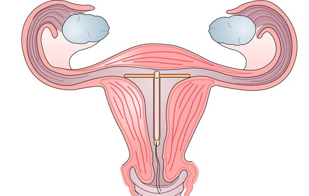 Внутрішньоматкова спіраль після пологів – ефективний спосіб контрацепції