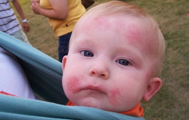Алергічний дерматит у немовлят thumbnail