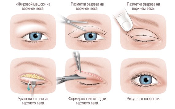 Блефаропластика   фото до і після, відгуки про операції, ціна