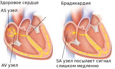 Брадикардія серця, що це таке, чи небезпечна вона для здоровя?