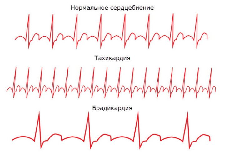 Брадикардія серця, що це таке, чи небезпечна вона для здоровя?