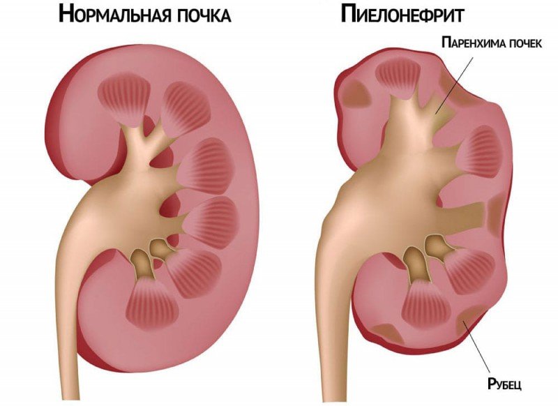 Лікування нефросклероза нирок (зморщеної нирки)