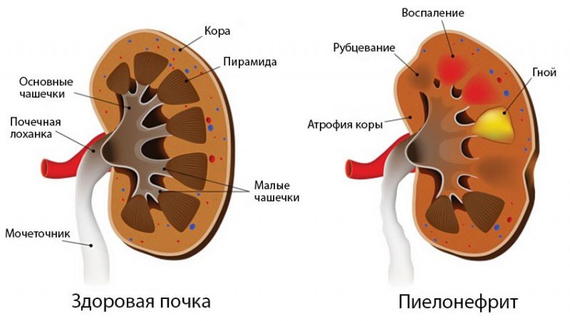 Гестаційний пієлонефрит при вагітності: симптоми і лікування