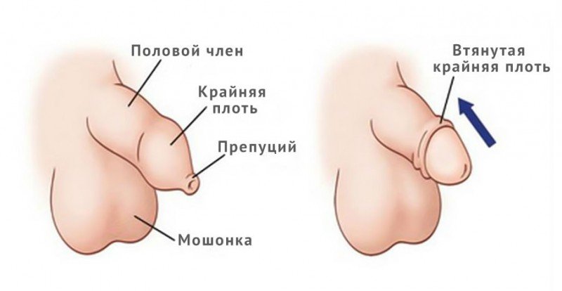 Фімоз у дорослих чоловіків — причини і лікування